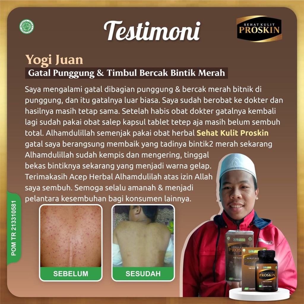 Penghilang Gatal di Punggung Panu Kurap Paling Alami Obat Alergi Gatel Kulit Herbal Penghilang Jerawat Biduran Bintik Gatel Jamur Kulit Benjolan Suplemen Kesehatan Ekstrak Binahong PROSKIN Tanpa Efek Samping Salep Cream Alat Pijat Garuk Menggaruk Punggung-5