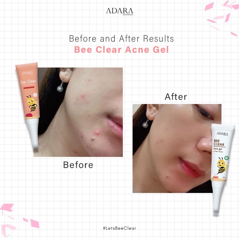 ADARA P.M.S Series Acne Spot Bee Clear Acne | Extra Formula | Serum Acne | Adara Moisturizer | Facewash Acne | Toner Acne | Acne Treatment jerawat