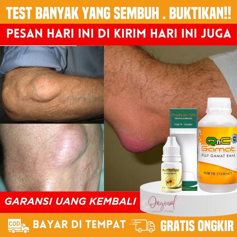 Penghancur benjolan lipoma, Obat penghilang benjolan, Obat Lipoma, Salep benjolan lipoma, Obat Benjo
