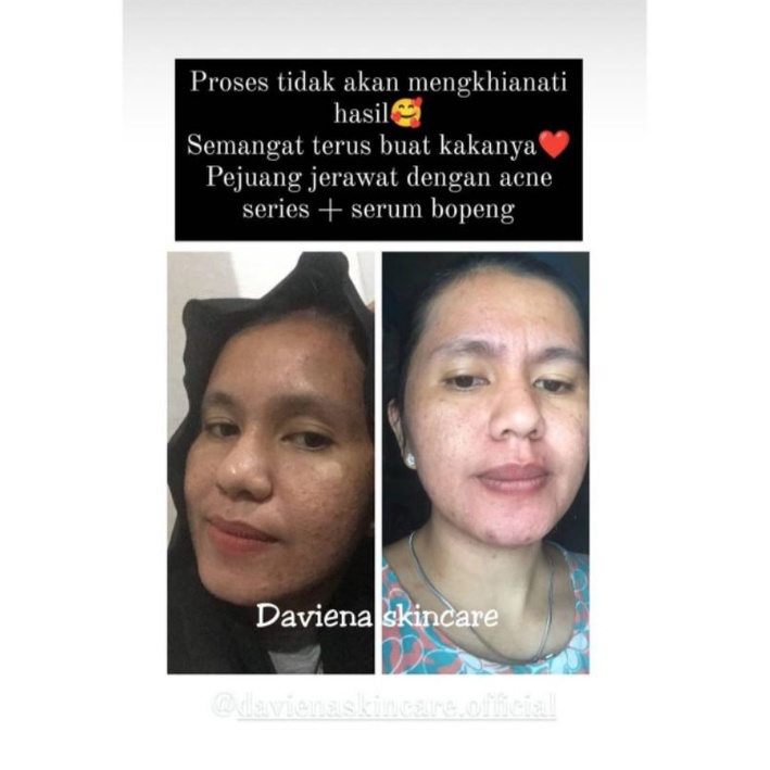 Daviena Skincare Paket Gold Series Davienaskincareofficial Davina Devina Lampung Surabaya Jakarta Pencerah Pemutih Flek Wajah Glowing Bpom Daviena Skincare-3