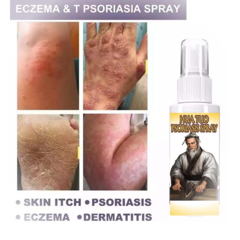 SALEP PSORIASIS SPRAY HUA TUO AMPUH ATASI GATAL DAN EKSIM