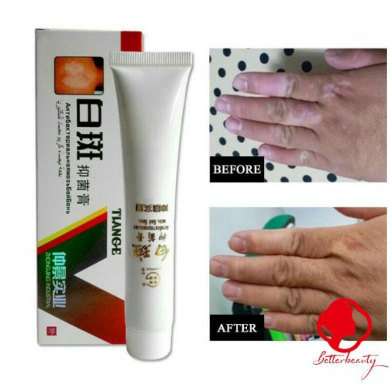 Original Salep Vitiligo Bercak Putih Bahan Herbal