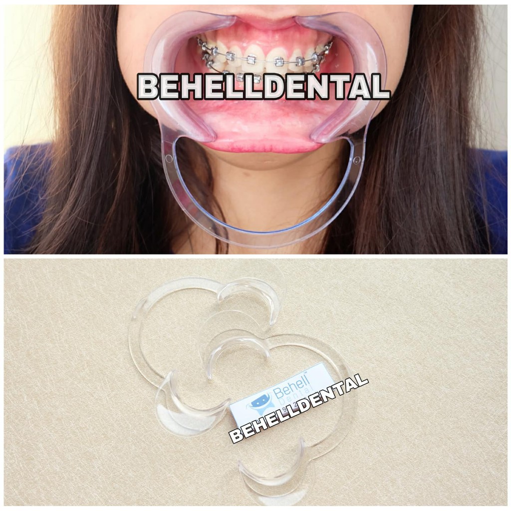 Pembuka Mulut | Dental Cheek Retractor | mouthgate penyangga rahang saat pasang bracket behel/ karet