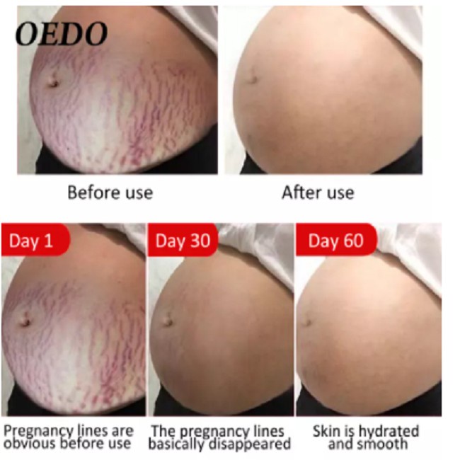 Rtopr Stretch Mark Cream  - Penghilang Strech Mark / Bekas Luka Ampuh Oermanen bpom Krim Stretch Mark