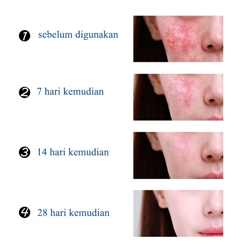 Krim Penghilang jerawat Ampuh 30g AMPUH Penghilang jerawat  permanen untuk wajah berjerawat dan bekas jerawat 6x Krim Jerawat Perbaikan Lemak Hiu Penghilang Jerawat Paling Ampuh Menghilangkan Jerawat dan Bekas Jerawat