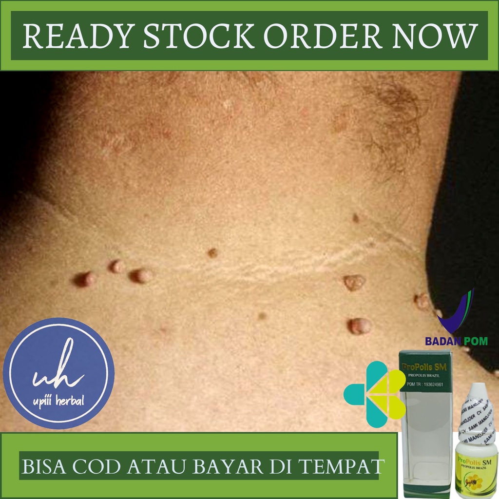 Obat Oles Perontok Papiloma, Obat Penghilang Papiloma Dikulit, Obat Papiloma Di Bibir, Leher, Tangan