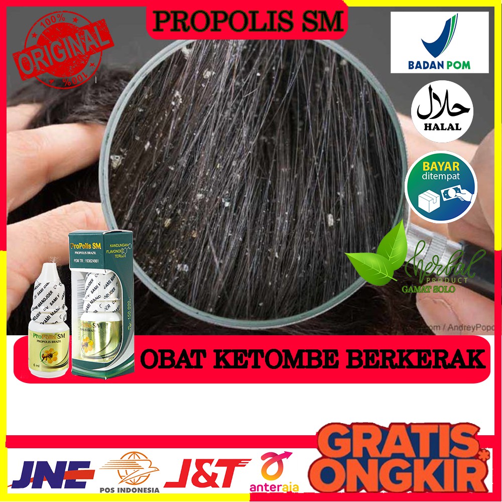 Obat Ketombe Berkerak, Ketombe Menahun, Ketombe Basah, Ketombe Kering - Propolis Sm di Solo (COD)