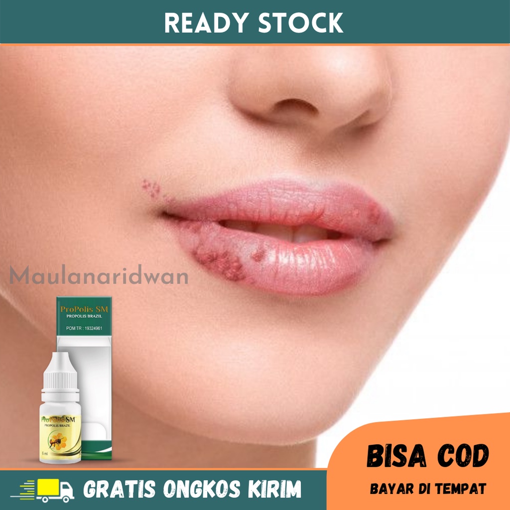 Obat Luka Lepuh Di Bibir - Obat Bintik Bintik Di bibir, Obat Gatal Gatal Di Area Bibir, Obat Bibir K