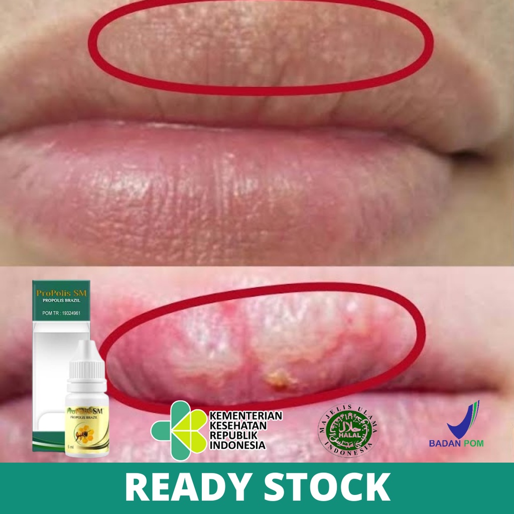 Obat Untuk Bintik Putih di Bibir, Bibir Bintik Bintik & Gatal, Bercak Putih di Sekitar Bibir, Fordyc