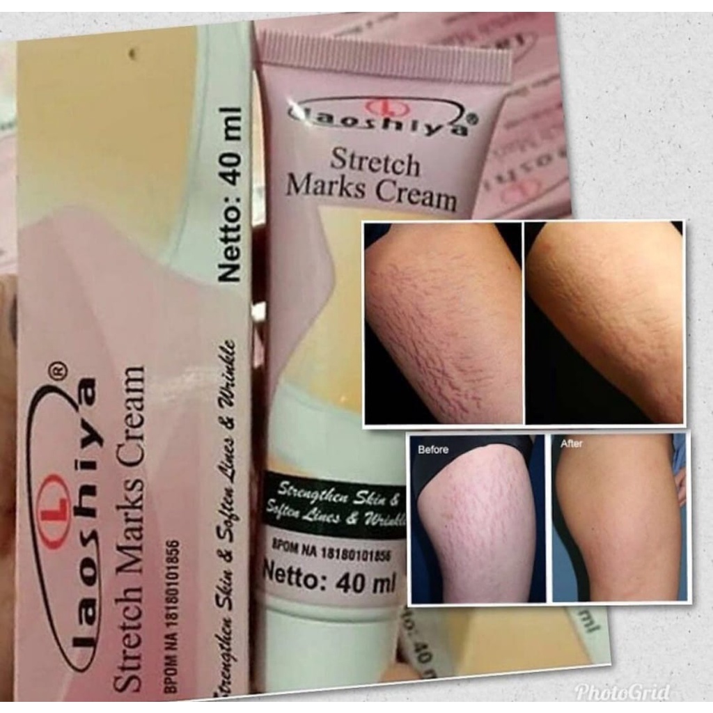 LAOSHIYA STRETCH MARKS CREAM ORIGINAL BPOM