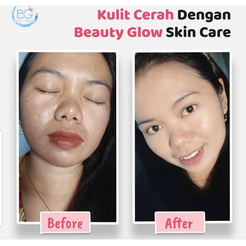 BG BEAUTY GLOW ULTIMATE SKIN/PAKET WAJAH BEAUTY GLOW FLEK