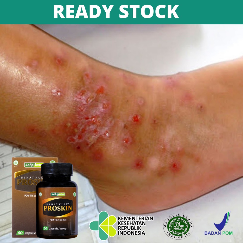 Obat Budugan, Obat Budug Bernanah, Borok, Obat Kaki Budug, Obat Budug Santri, Obat Gudik, Obat Scabi