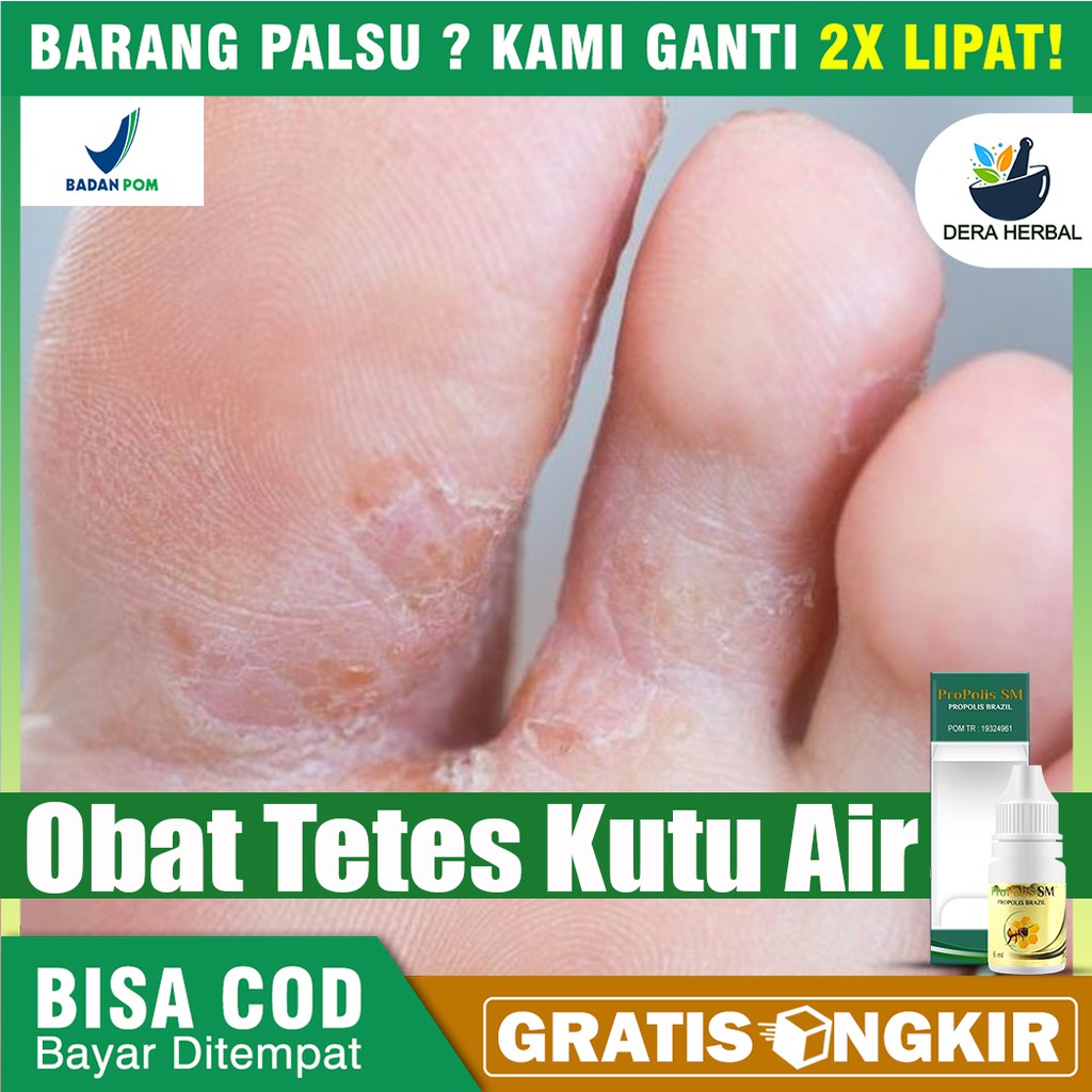 Obat Tetes Kutu Air, Obat Kutu Air Kaki & Tangan, Obat Tetes Kuman Air Herbal Propolis Sm Bisa COD