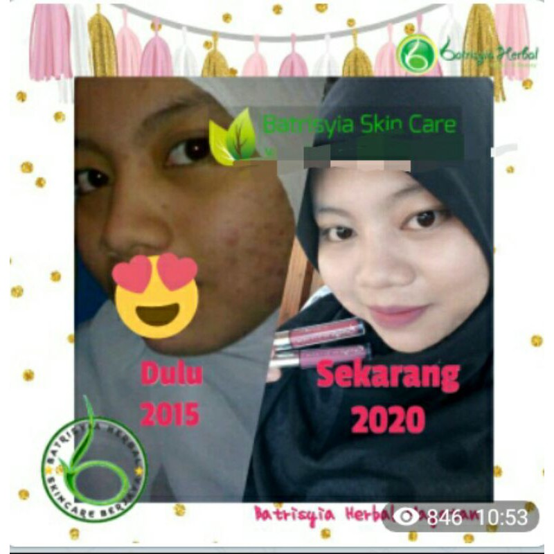 Batrisyia Herbal Acne cream totol jerawat besar meradang bruntusan