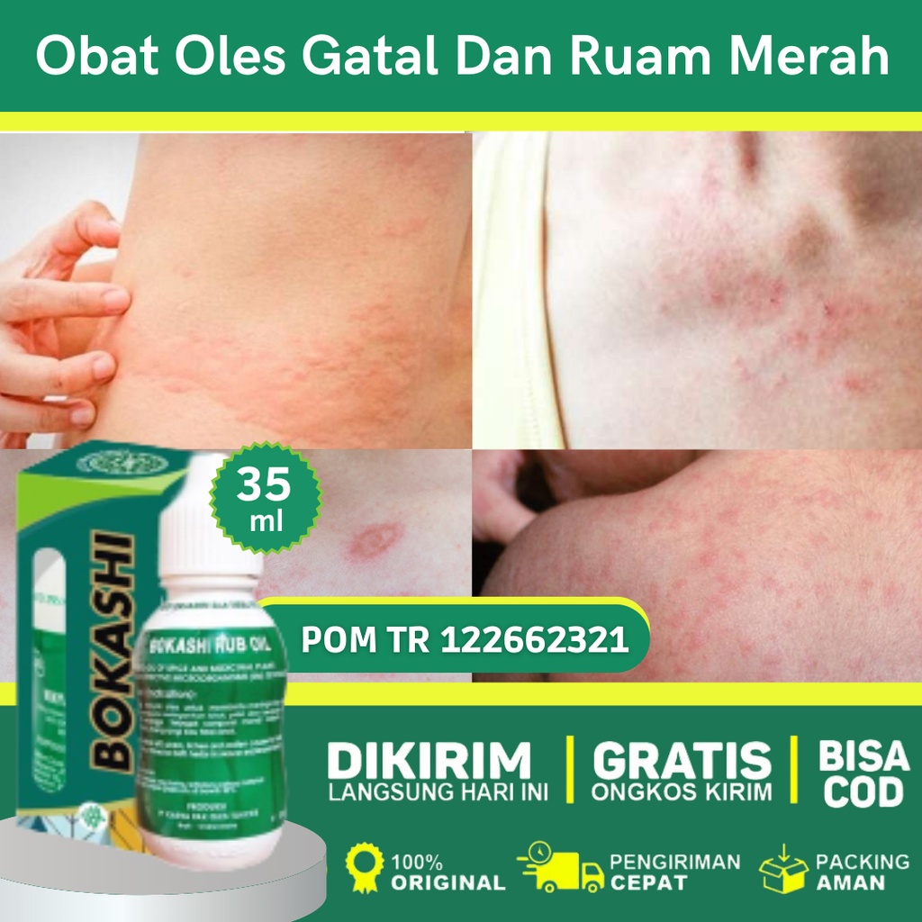 Obat Kulit Gatal, Gatal Alergi, Biduran, Bentol Gatal, Bentol di Kelamin, Bentol Alergi, Obat Alergi