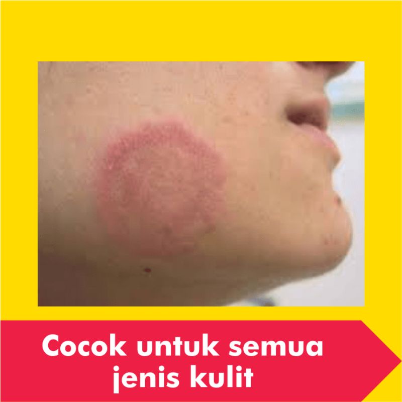 Salep Obat Kurap Kudis Paling Ampuh Gatal Kulit Gatel Kadas Eksim Kering Kutu Air Jamur Selangkangan-5