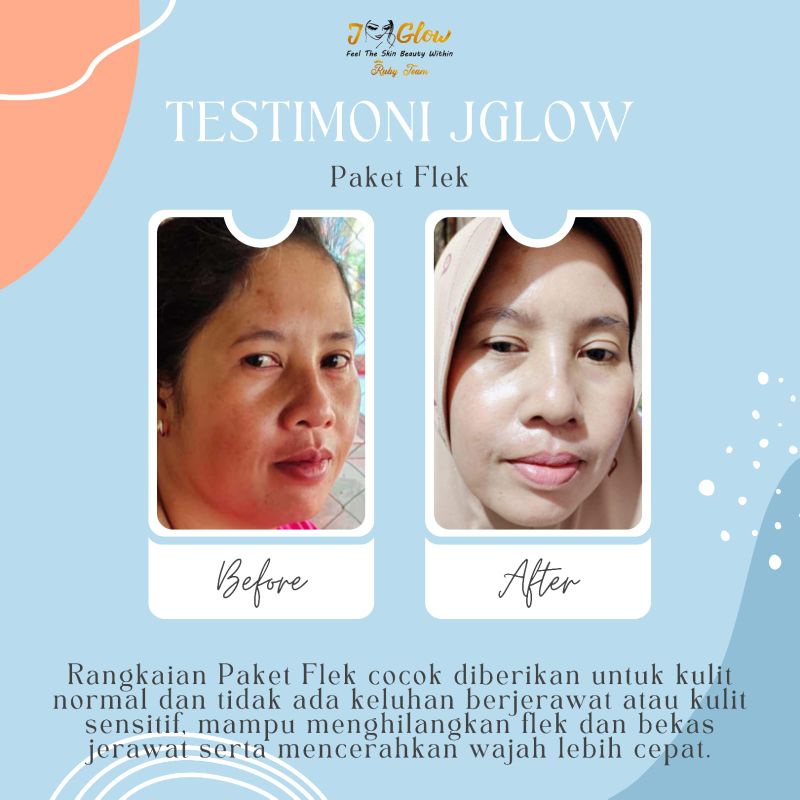 JGlowSkincare/PaketFlekFeeling/FlekHitam/BekasJerawat/Bopeng