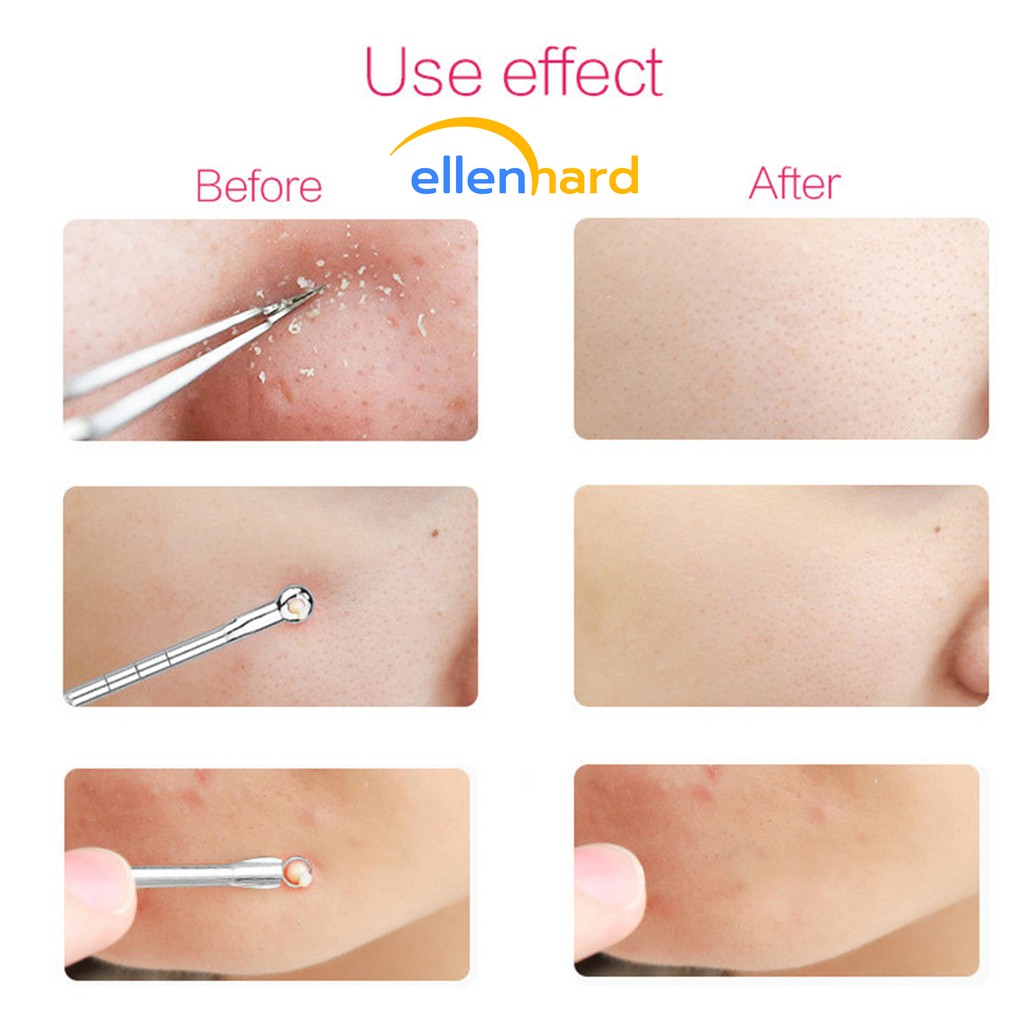 Pinset Alat Pencabut Komedo Set Pengangkat Pencetan Komedo Jerawat Blackhead Remover Kit Stainless Steel