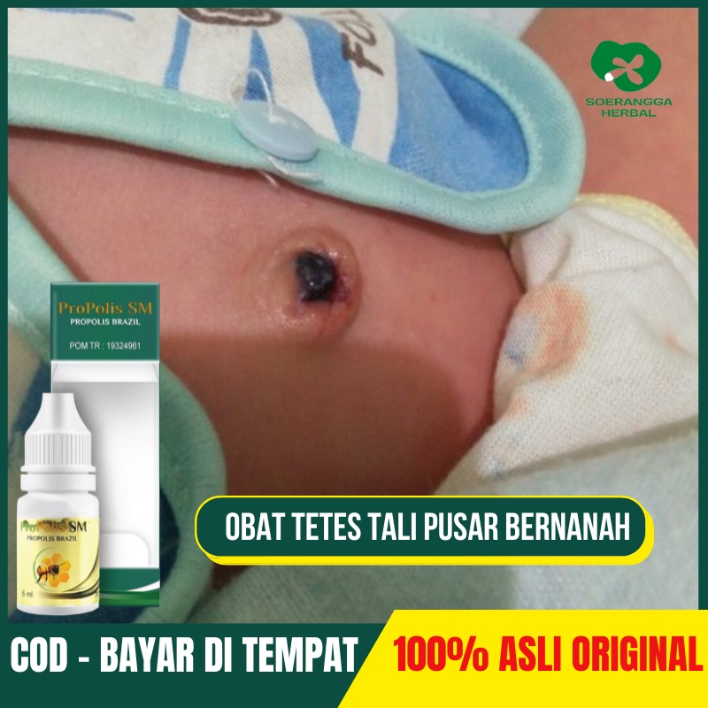 Obat Pusar Bernanah Bau Busuk, Pusar Berair, Obat Pusar Bengkak Untuk Anak, Bisul Di Pusar, Obat Men