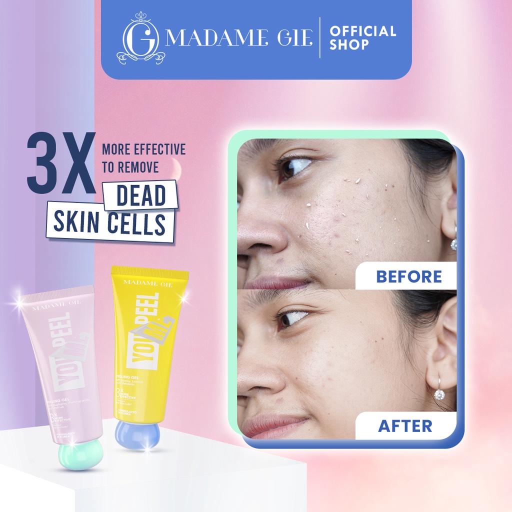 Madame Gie Madame You Peel Me Peeling Gel Mengurangi Kemerahan Pada Kulit