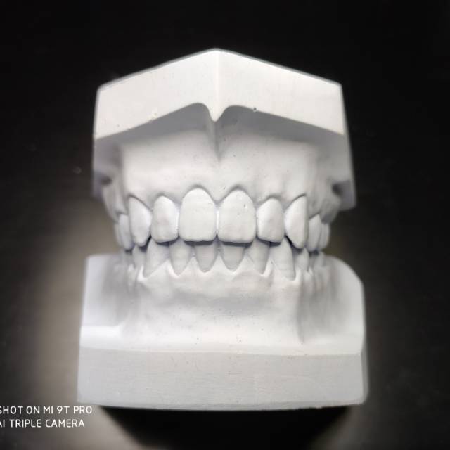 Model study gips gipsum gigi dental