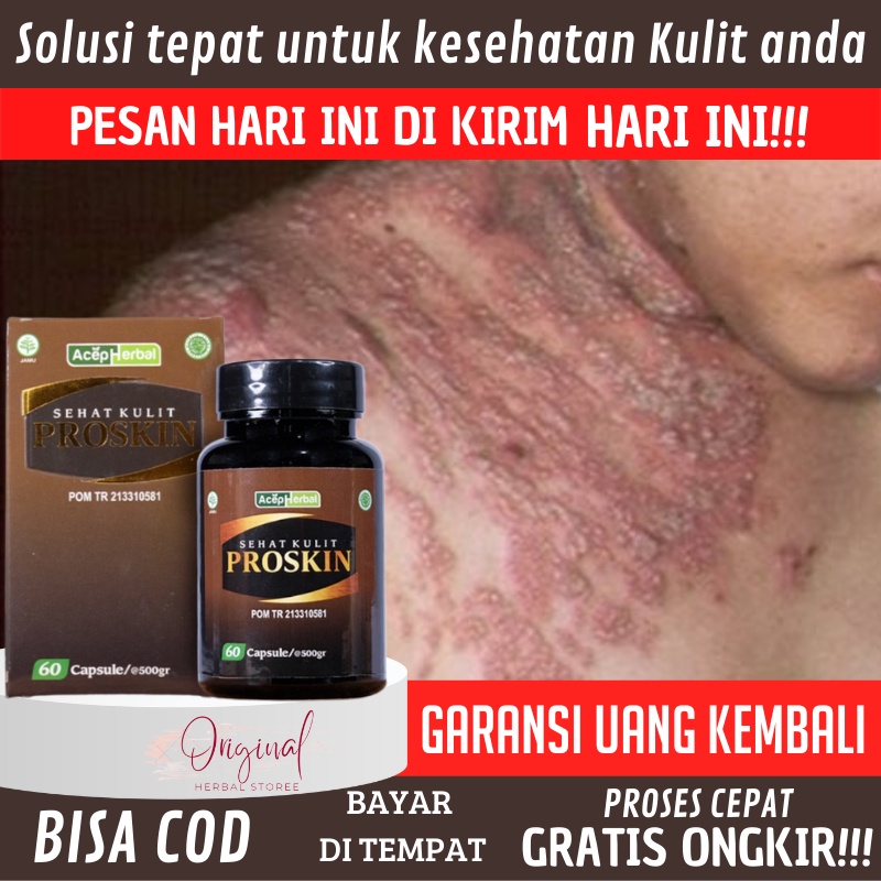 Jual Obat Eksim kering dan basah, Salep eksim basah, Obat eksim, Obat