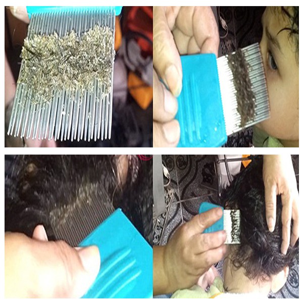 Sisir Kutu Rambut | Sisir Serit Gagang | Sisir Pengilang Ketombe | Sirkut Kutu Gagang