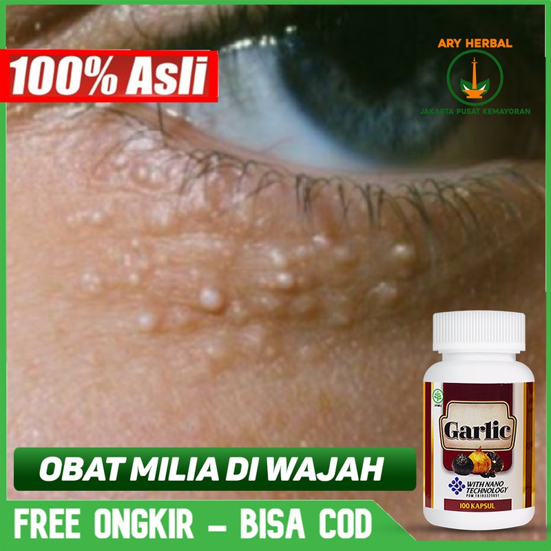 Jual Obat Milia Di Bawah Mata Hidung Wajah Syringoma Alami Garlic