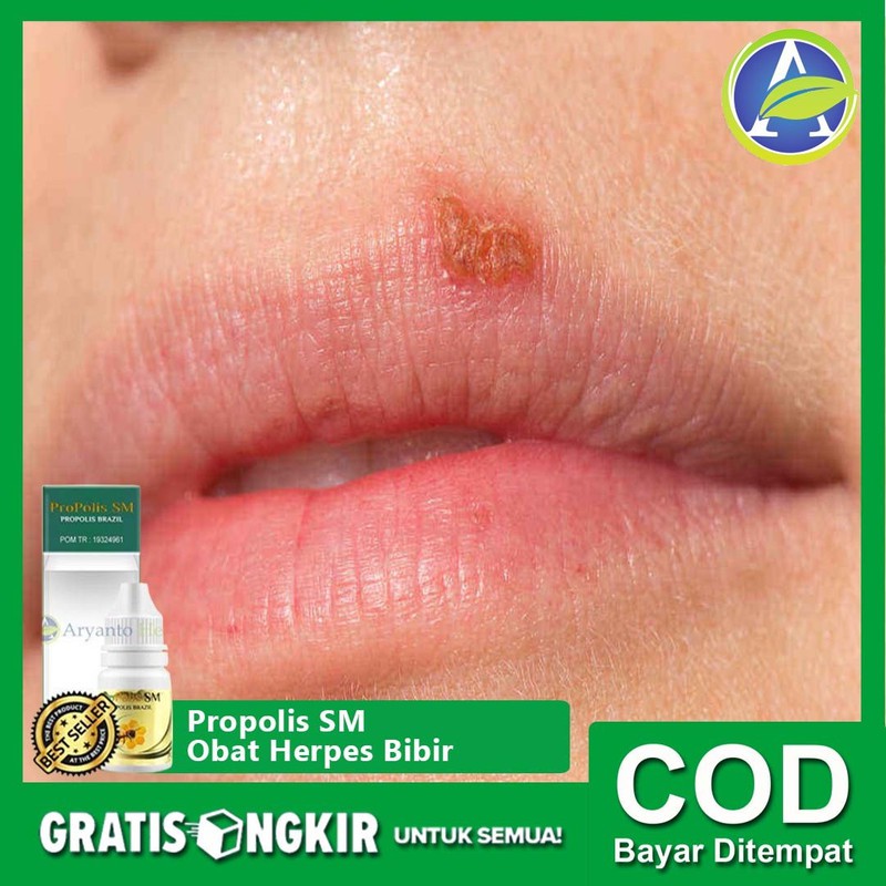 Obat Herbal Herpes Termurah di Bibir, Kelamin, Pantat Propolis SM Brazil Di Tasikmalaya Bisa COD