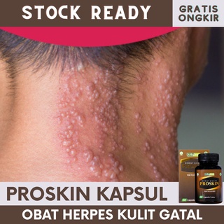 Jual Obat Herpes Kulit Gatal, Obat Herpes Zoster, Obat Herpes Dompo