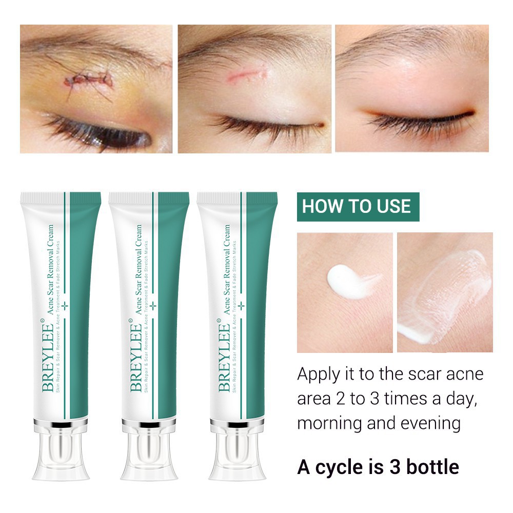 PENGHILANG JERAWAT BREYLEE Acne Simple Treatment A Perawatan Wajah Berjerawat 3 pcs