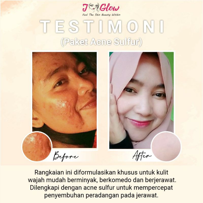 Jglow skincare PAKET EXTRA ACNE SULFUR )AMPUH MENGATASI MASALAH JERAWAT BATU/MERADANG