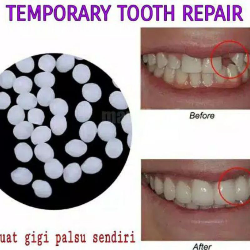 TEMPTOOTH GEL UNTUK PERBAIKAN GIGI/MEMBUAT GIGI PALSU/MENAMBAL GIGI LUBANG/PATAH