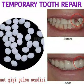 Temptooth Gel Untuk Membuat Gigi Palsu Menambal Gigi Bolong Bisa Jadi Lem Gigi Palsu Shopee Indonesia