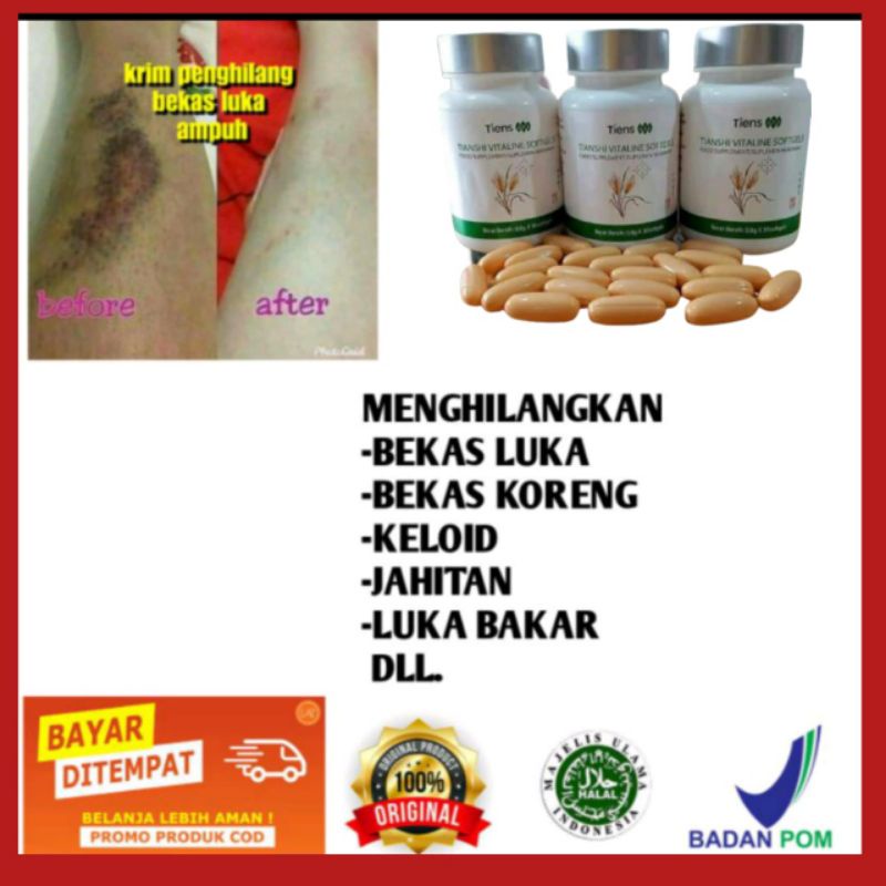 3x OLES 7 HARI HILANG PERMANEN BEKAS LUKA, KORENG, KELOID, GATAL, STRECHMARK (BAYAR DITEMPAT)