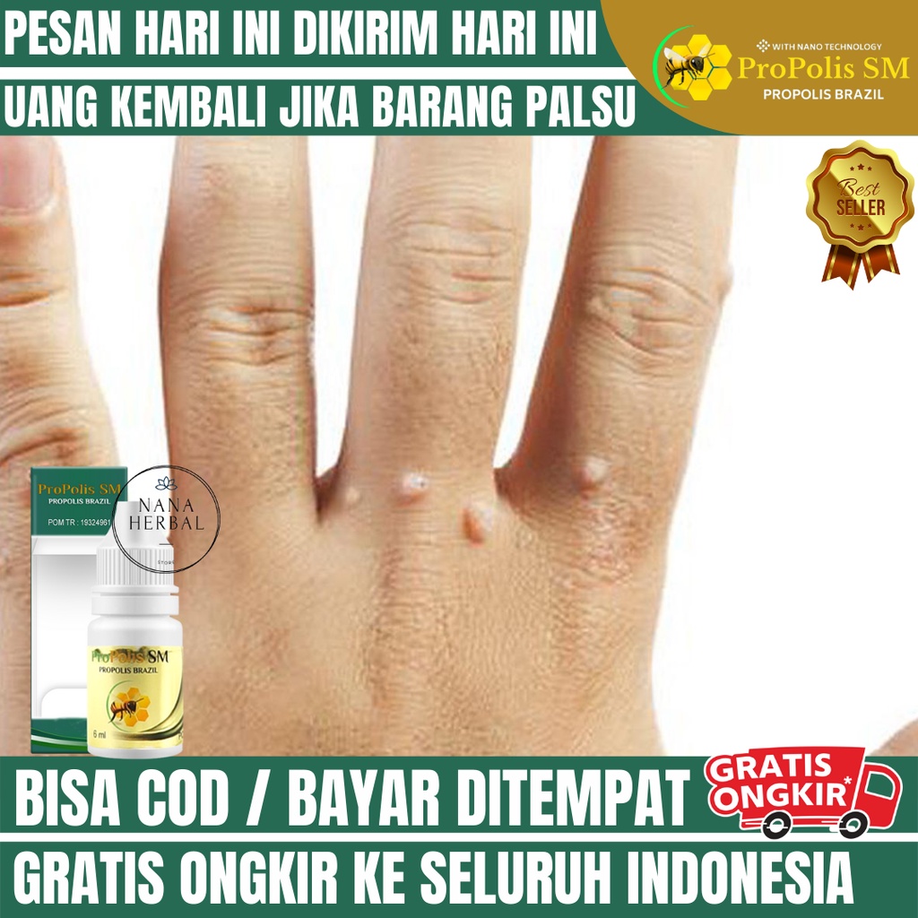 Obat Kutil Di Tangan, Obat Papiloma Perontok Kutil, Obat Kutil Pada Kelamin, Obat Kutil Di Wajah, Ob