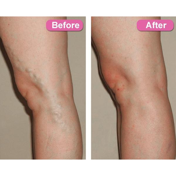 Varicose Veins Treatment Cream / Salep Penghilang Varises