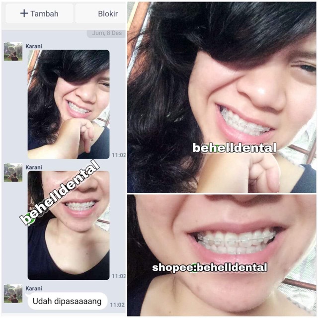 Paket Behel Gigi Permanen Ceramic Classone USA sikat ortho keramik transfaran transparant transparan