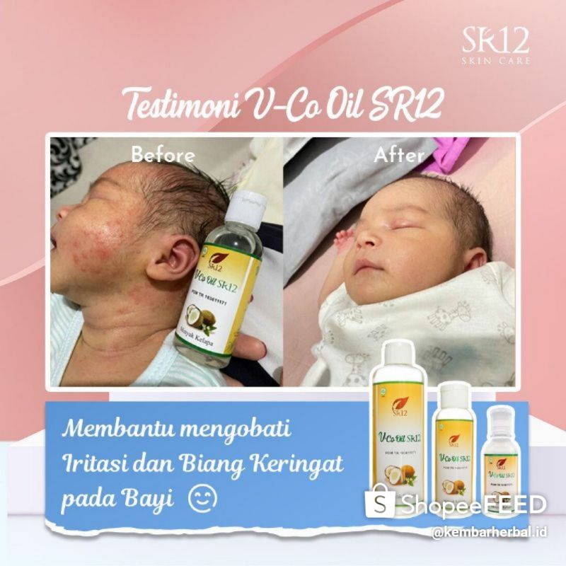 VICO SR12 AMPUH ATASI RUAM PADA BAYI RUAM POPOK RUAM PIPI BIANG KERINGAT GATAL GATAL/OBAT SARAB BAYI