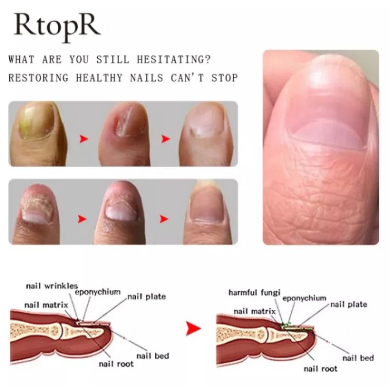 RtopR NAIL TREATMENT | PERAWATAN JAMUR KUKU |