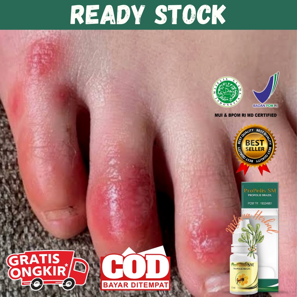 Obat Bisul Di Kaki, Penghilang Bekas Luka Bisul, Bisul Bernanah, Cenang, Bisulan, Perih Di Kulit