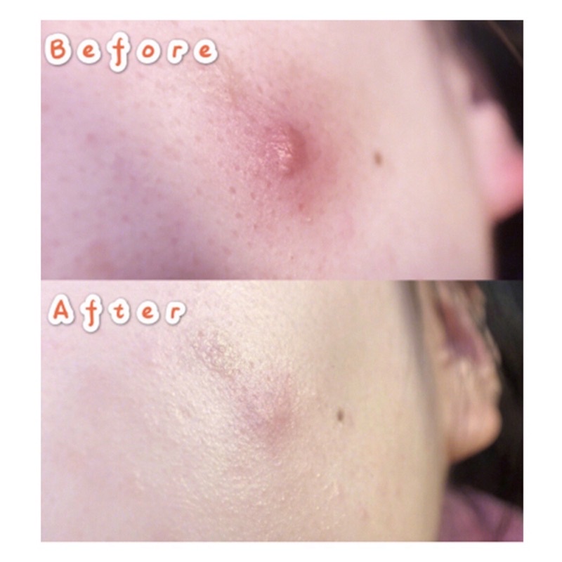 LANBENA Acne Pimple Patch Obat Jerawat Masker Jerawat Penghilang Jerawat Stickers Invisble Stiker Perawatan jerawat Oil Control Anti Jerawat Perawatan kulit