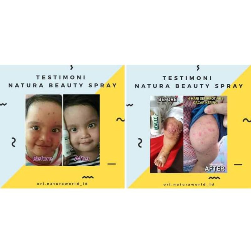 Natura beauty spray obat cacar ,jerawat ,scabies , bentol flek hitam, komedo,biang keringat