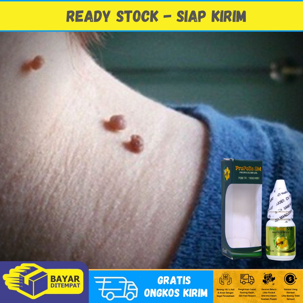 Obat Kutil Leher Papiloma, Penghilang Papiloma di Leher, Kelopak Mata dan Wajah - Propolis SM