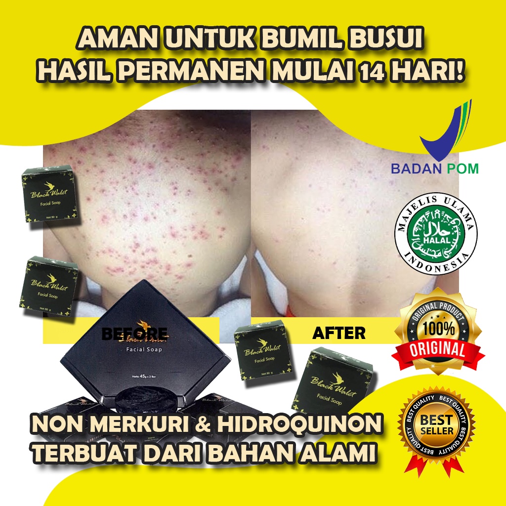 WALET SOAP SABUN JERAWAT PUNGGUNG OBAT JERAWAT PUNGGUNG SABUN JERAWAT UNTUK PUNGGUNG PENGHILANG JERA
