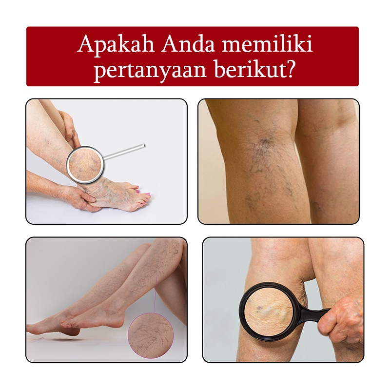 Terlaris !!! Varicose Veins Obat Varises Varikokel Bengkak Benjolan Buah Zakar Nyeri Testis Paling Ampuh Varicose Veins Treatment Cream/Obat Krim Varises Parises Tanpa Operasi