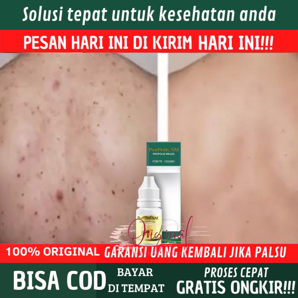Obat Jerawat di punggung, Penghilang jerawat Punggung, Salep Jerawat punggung dan bekasnya, Obat jer