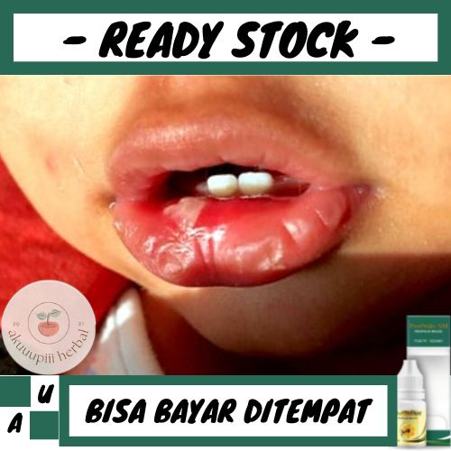 Obat Sariawan Pada Bayi, Obat Sariawan Dimulut, Obat Lesi Mulut, Obat Luka Didalam Mulut - Herbal Pr