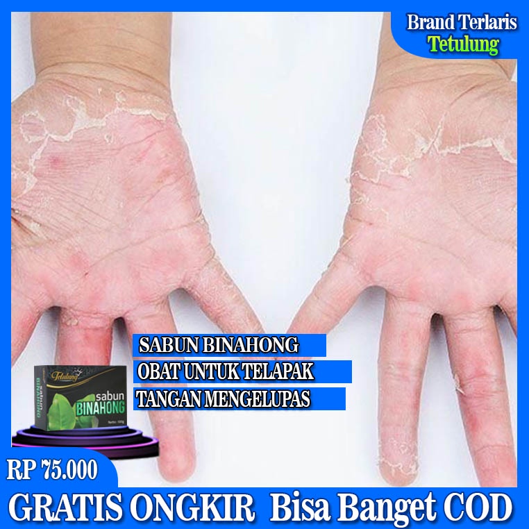 Sabun Binahong, Obat Untuk Kulit Telapak Tangan Mengelupas, Kulit Telapak Tangan Mengelupas Parah, K