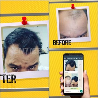  OBAT  PENUMBUH RAMBUT  ORIGINAL CEPAT AKIBAT RONTOK 100 